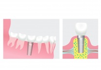 Zahntechnikdentallabor-Berlin Zahnersatz Bild 4